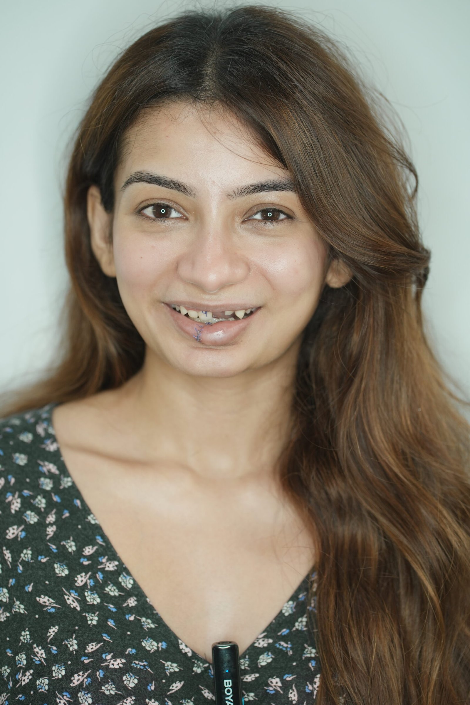Before — Whitening
