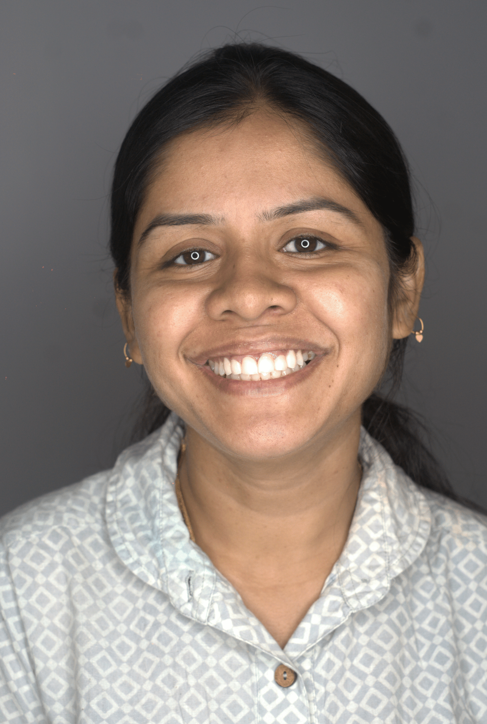 After — Smile makeover