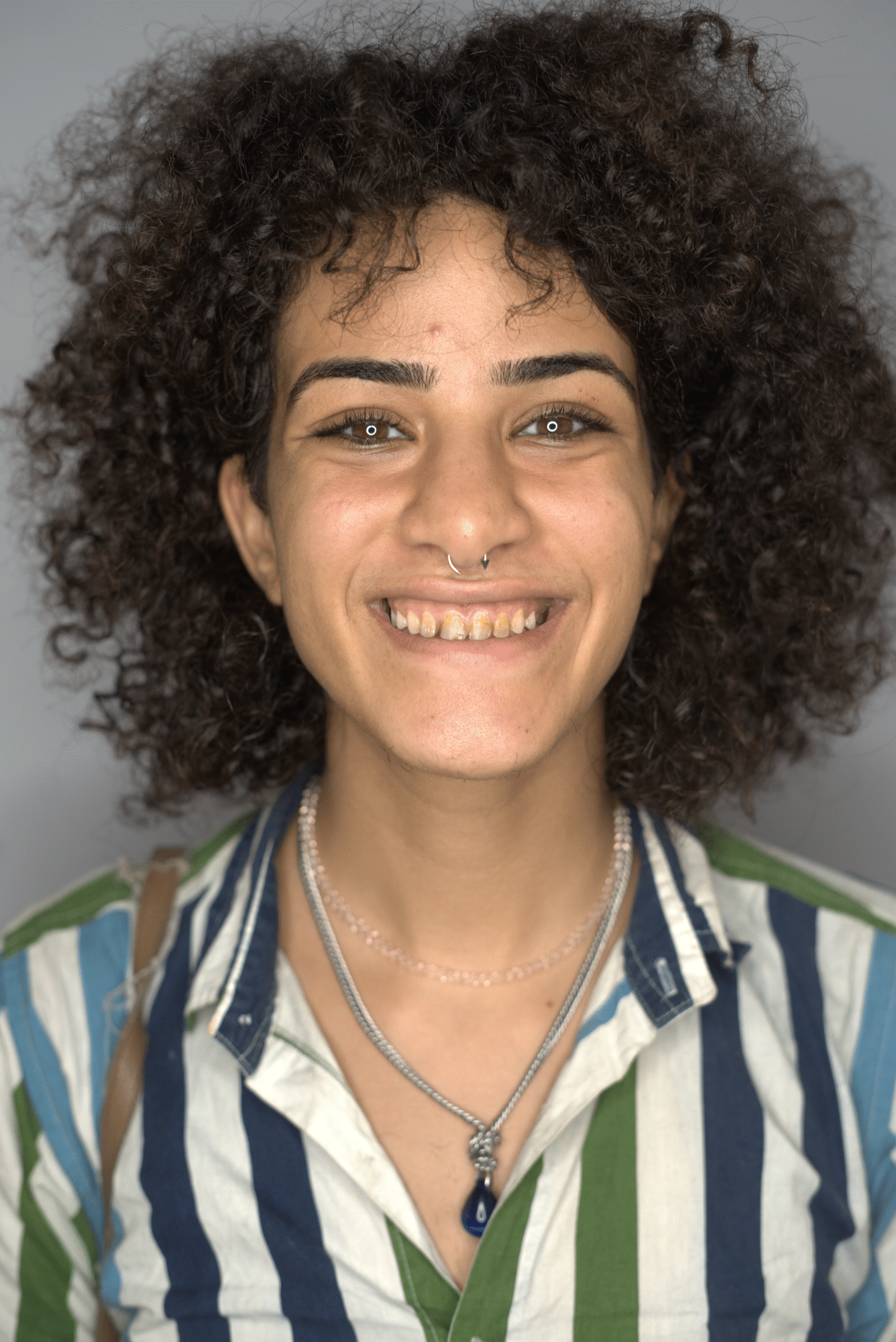 Before — Smile makeover